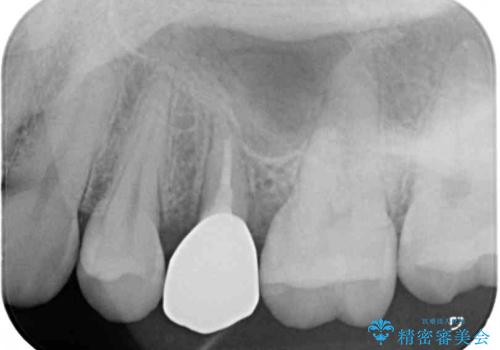 抜歯と言われた歯を残したい 部分矯正と外科処置を用いた補綴治療の治療後