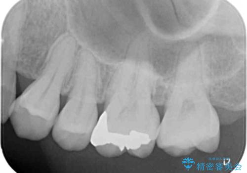 歯と歯の間の虫歯　ゴールドインレーでの修復の治療後