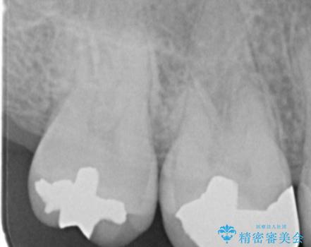 縁下歯石のクリーニングの治療後