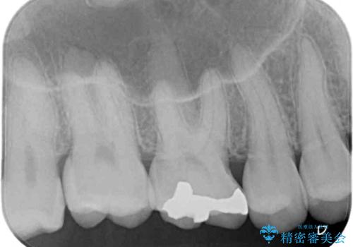 銀歯をセラミックにしたい セラミックインレー修復の治療前
