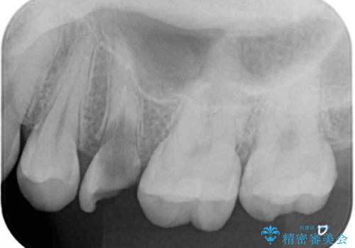 抜歯と言われた歯を残したい 部分矯正と外科処置を用いた補綴治療の治療前