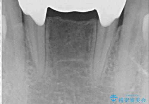 乳歯残存と欠損の前歯 矯正治療とオールセラミックブリッジ治療の治療後