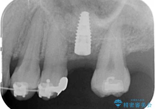 他院での矯正治療中 ソケットリフトを伴うインプラント治療依頼の治療中