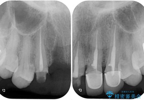 長く見える歯を治したい　歯肉移植による歯肉増大術の治療前
