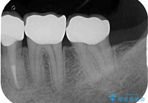 痛みの続く大きな虫歯の奥歯　オールセラミッククラウンでの補綴治療の治療後