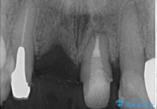 ぐらつく前歯 ブリッジ治療の治療中