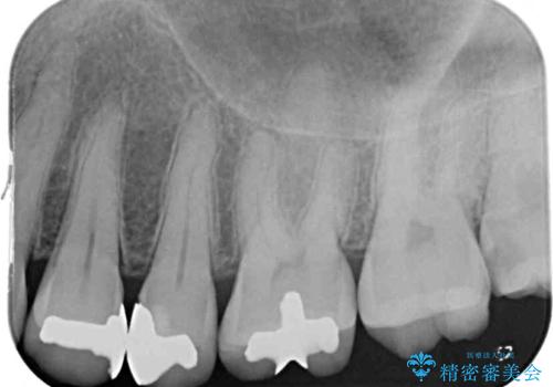 銀歯をセラミックにしたい セラミックインレー修復の治療前