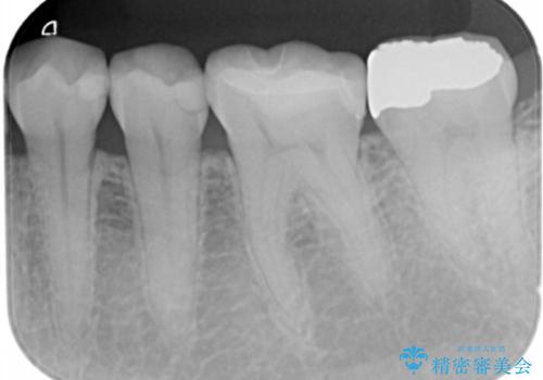 歯が黒くて虫歯じゃないかと心配して来院の治療後