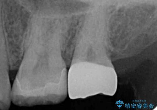 奥歯の放置した虫歯 セラミックでの治療の治療後