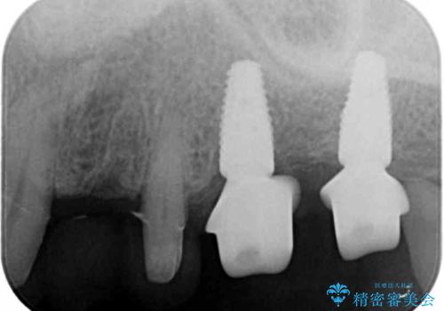[ 歯周病治療 ] 小矯正を含むインプラント補綴・歯周補綴の治療中