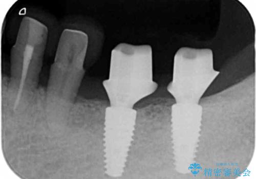[ 歯周病治療 ]　小矯正を含むインプラント補綴・歯周補綴の治療中