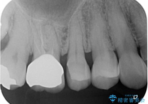 セラミックインレーのやりかえの治療前