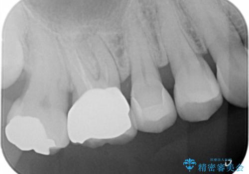 セラミックインレーのやりかえの治療後