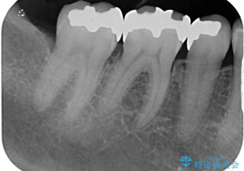 銀歯をセラミックにしたい セラミックインレー修復の治療前