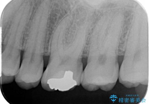 検診で虫歯を発見。の治療後