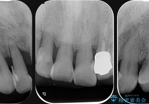 歯周病治療を伴う前歯審美セラミック治療の治療前