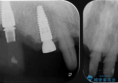 歯周病治療を伴う前歯審美セラミック治療の治療中
