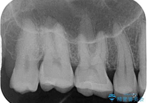 銀歯をセラミックにしたい セラミックインレー修復の治療後