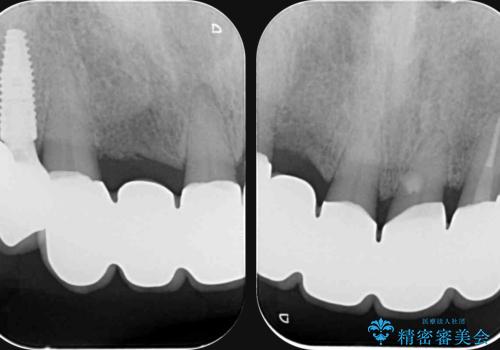 歯周病治療を伴う前歯審美セラミック治療の治療後