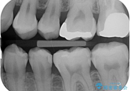 e-maxインレーによる治療の治療前