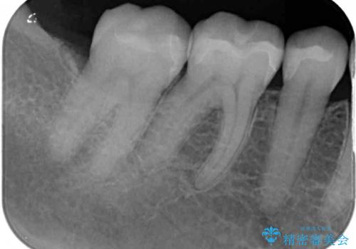 銀歯をセラミックにしたい セラミックインレー修復の治療後