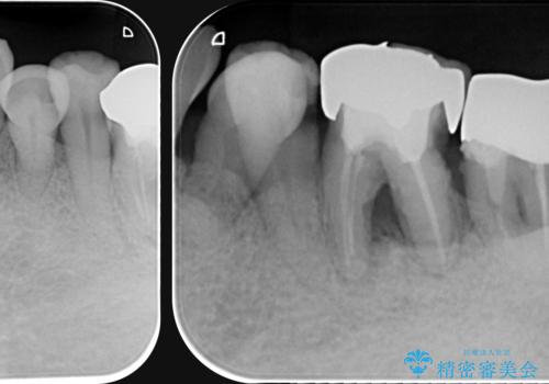 [ 歯周病治療 ]　小矯正を含むインプラント補綴・歯周補綴の治療前
