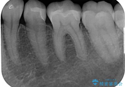 銀歯をセラミックにしたい セラミックインレー修復の治療後