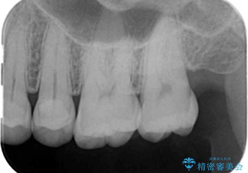 奥歯の深くて確認しにくい虫歯 ゴールドインレーでの治療の治療前