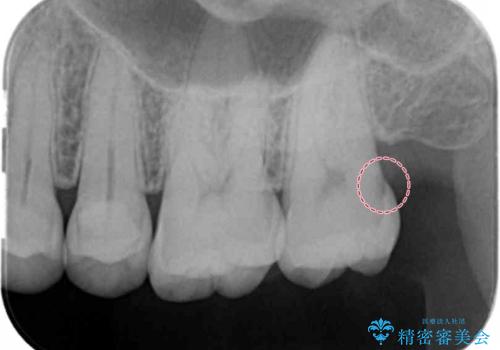 奥歯の深くて確認しにくい虫歯 ゴールドインレーでの治療