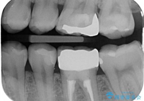 ジルコニアクラウン治療の治療前
