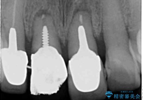 ぐらつく前歯 ブリッジ治療の治療前