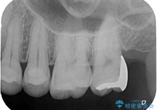 奥歯の深くて確認しにくい虫歯 ゴールドインレーでの治療の治療後