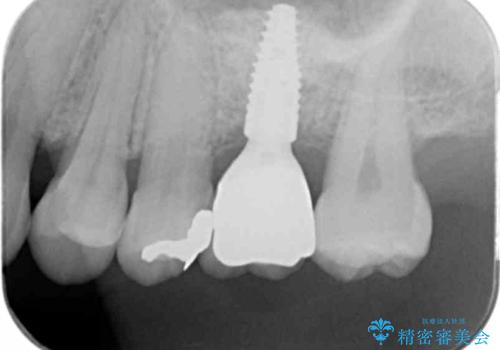 他院での矯正治療中 ソケットリフトを伴うインプラント治療依頼の治療後