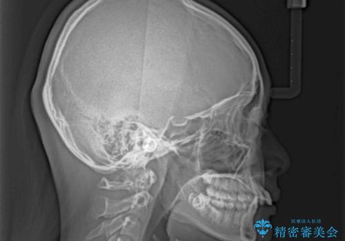 深い咬み合わせで前方に煽られた前歯 高校生のインビザライン矯正治療の治療前