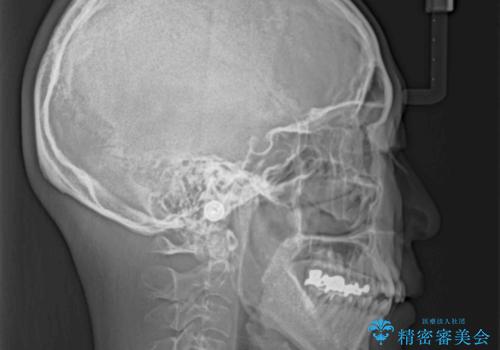 閉じにく口元と欠損歯列 ワイヤー装置の抜歯矯正の治療前