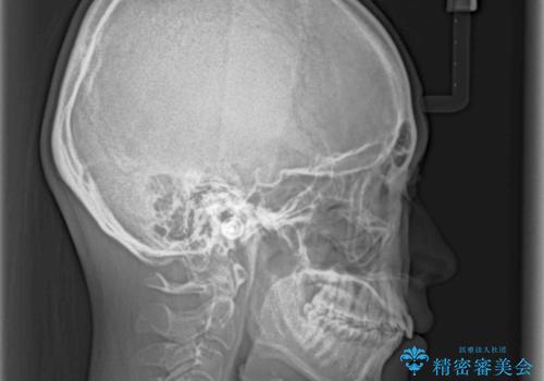 前にずれた咬み合わせをワイヤー装置でしっかりと改善の治療前