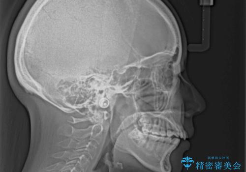 【モニター】カリエールディスタライザーとインビザラインを用いた奥歯の咬み合わせ改善の治療前