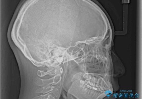 目立たない装置で出っ歯を治したい ハーフリンガル矯正の治療前