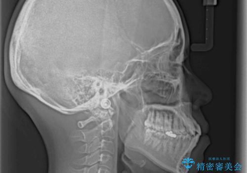 受け口傾向の歯並びをインビザラインで改善の治療前