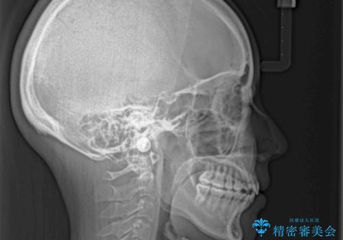 【モニター】カリエールディスタライザーとインビザラインを用いた奥歯の咬み合わせ改善の治療後