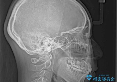 目立たない装置で出っ歯を治したい ハーフリンガル矯正の治療後