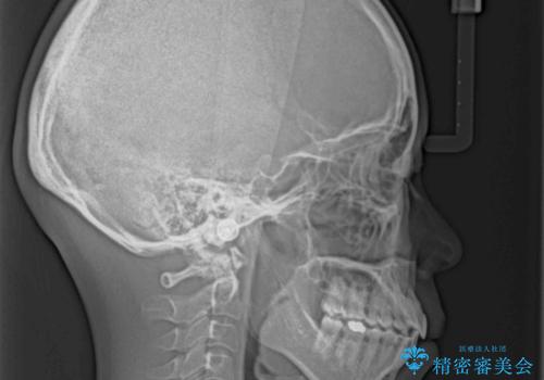 受け口傾向の歯並びをインビザラインで改善の治療後
