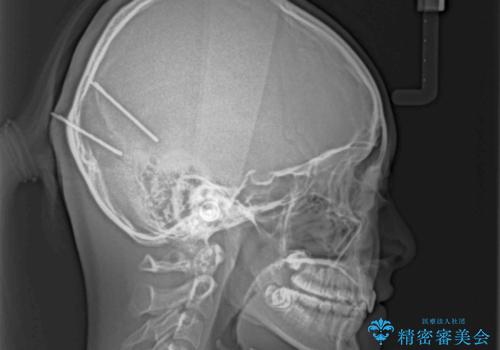 深い咬み合わせで前方に煽られた前歯 高校生のインビザライン矯正治療の治療後
