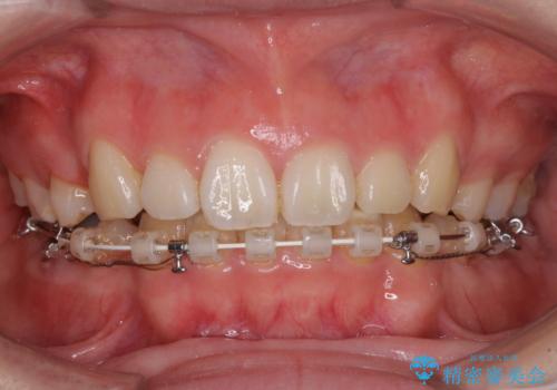目立たない装置で出っ歯を治したい ハーフリンガル矯正の治療中