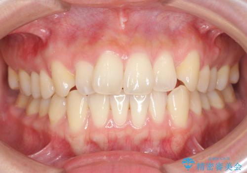 前歯のねじれを改善　マウスピース矯正インビザラインの治療前