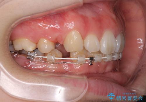 目立たない装置で出っ歯を治したい ハーフリンガル矯正の治療中