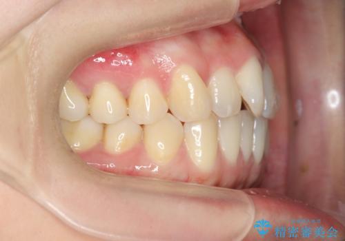 前歯のねじれを改善 マウスピース矯正インビザラインの治療前