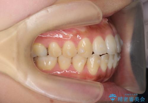 [ 前歯開咬 ]   前歯が噛んでいない マウスピース矯正治療の治療中