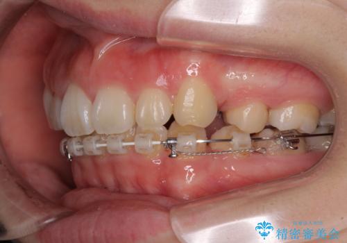 目立たない装置で出っ歯を治したい ハーフリンガル矯正の治療中