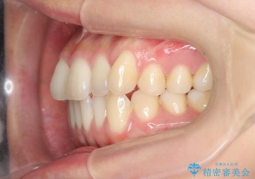 前歯のねじれを改善　マウスピース矯正インビザラインの治療前